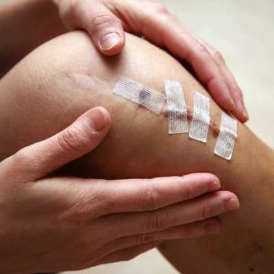 Lees hier over het verloop van een knieoperatie en welke hulpmiddelen jou kunnen ondersteunen. Lees hier over het verloop van een knieoperatie en welke hulpmiddelen jou kunnen ondersteunen.